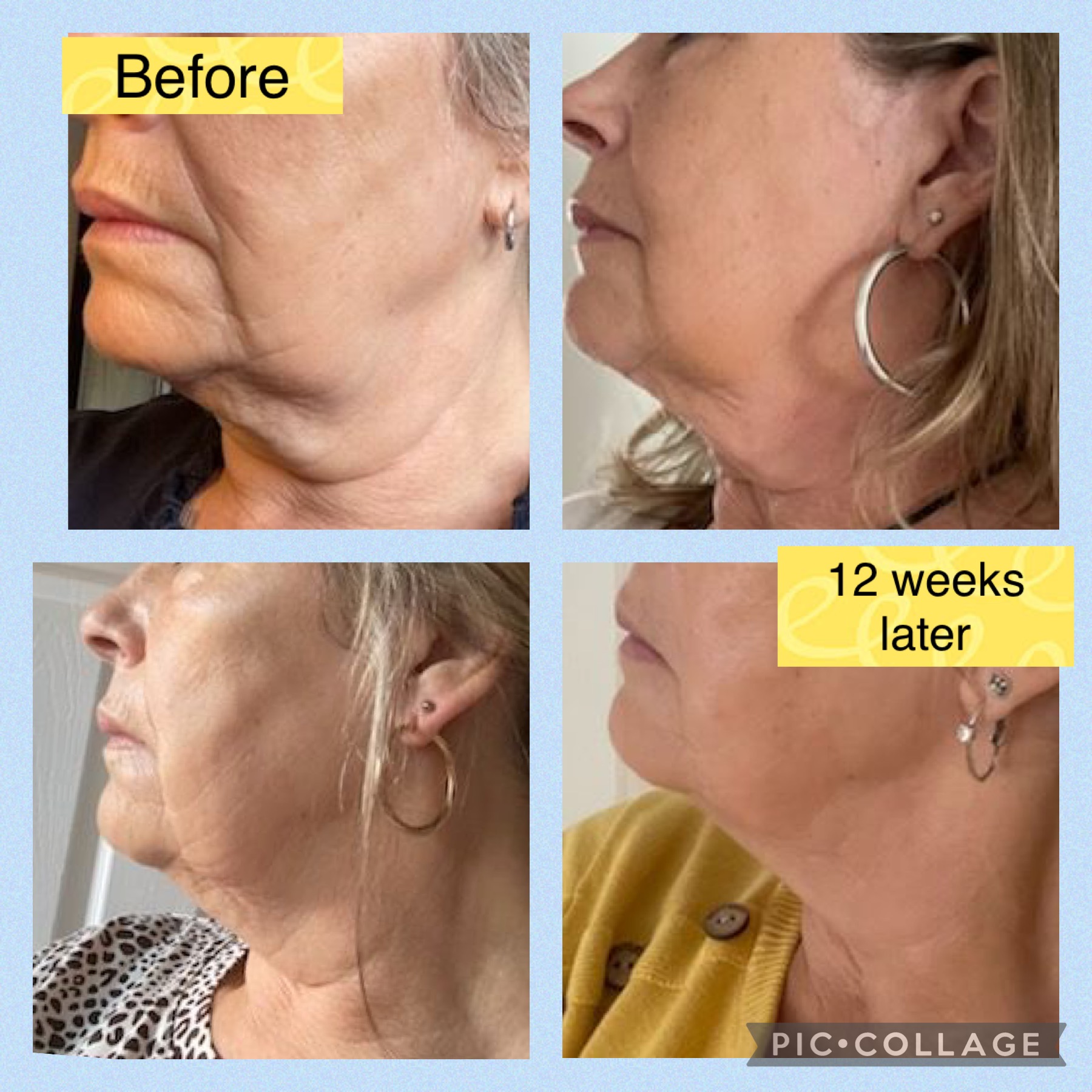 Before after jaw line treatment