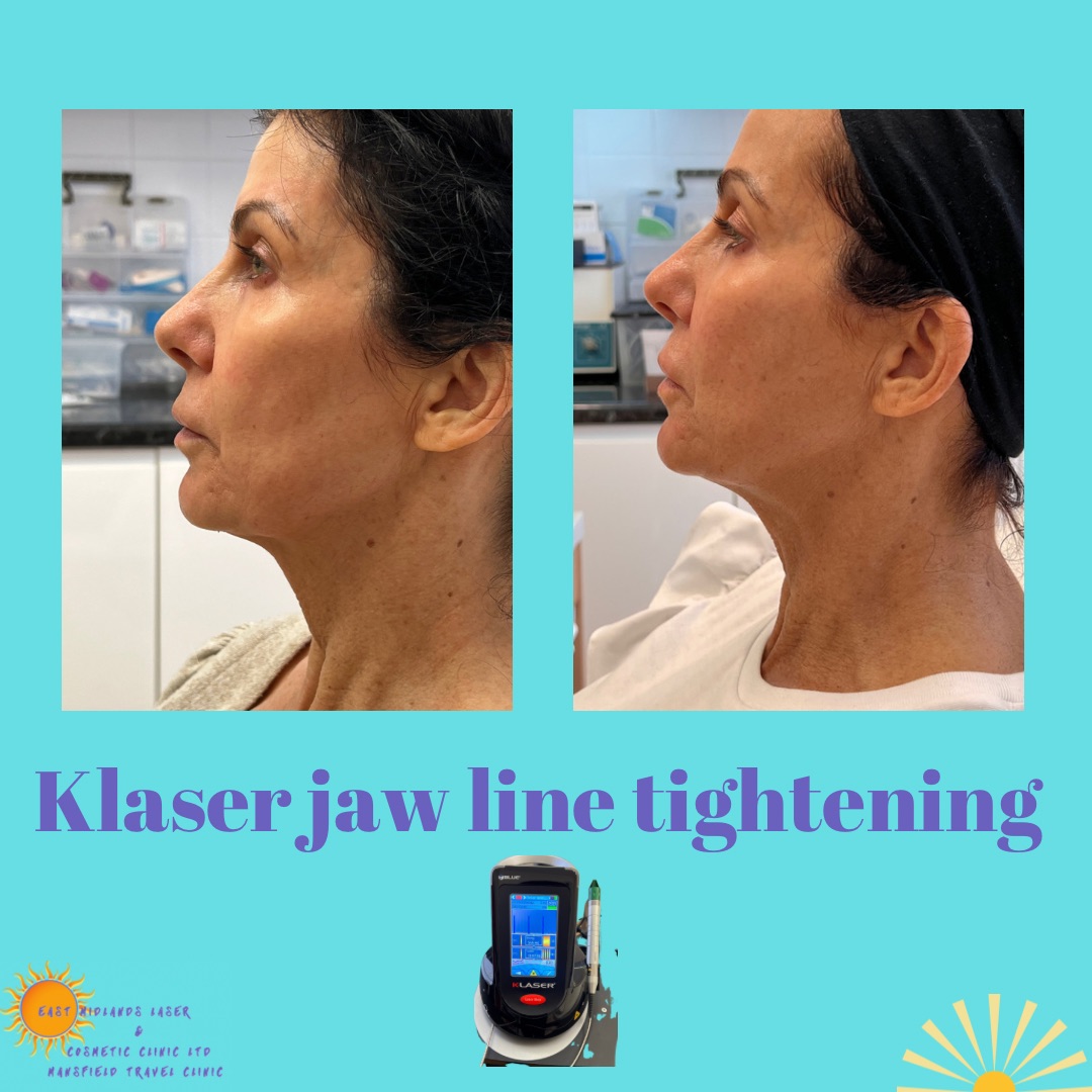 Before after jawline tightening