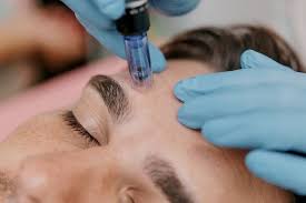 Micro-needling treatment