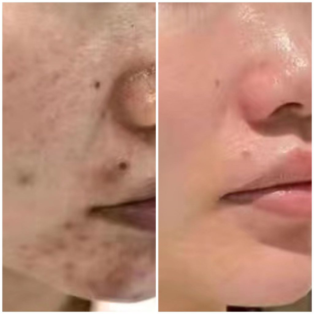 Before after picture