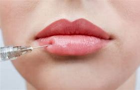 lip filler